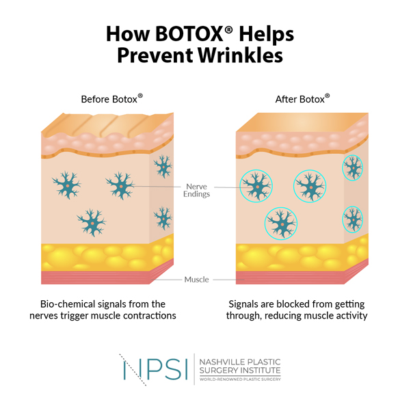 BOTOX® from Nashville Plastic Surgery Institute blocks chemical messages that trigger wrinkle-forming contractions.