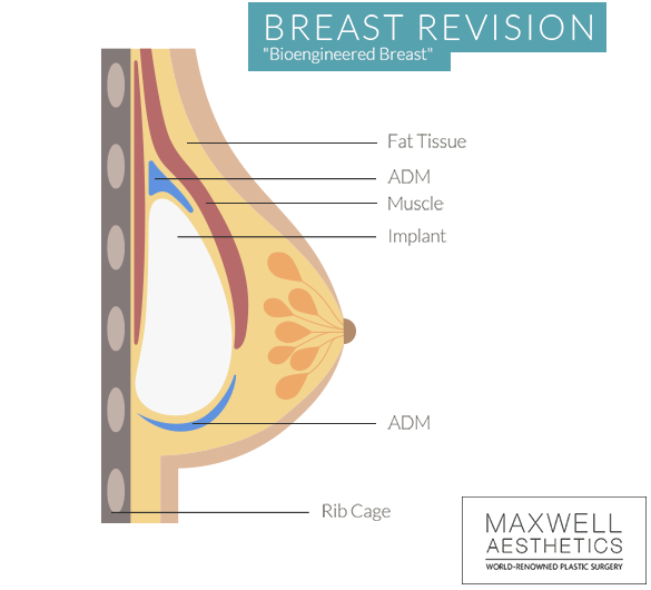Dr. Jacob Ungers bioengineered breast revision is a two-stage process involving acellular dermal matrix, and implant, and fat transfer for successful breast revision in Nashville.