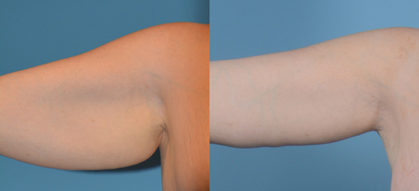 Arm Lift - Before and After