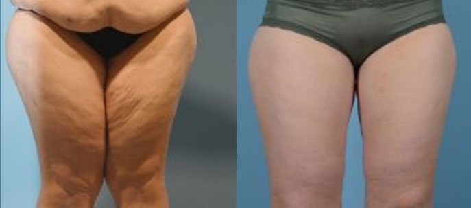 Thigh Lift - Before and After