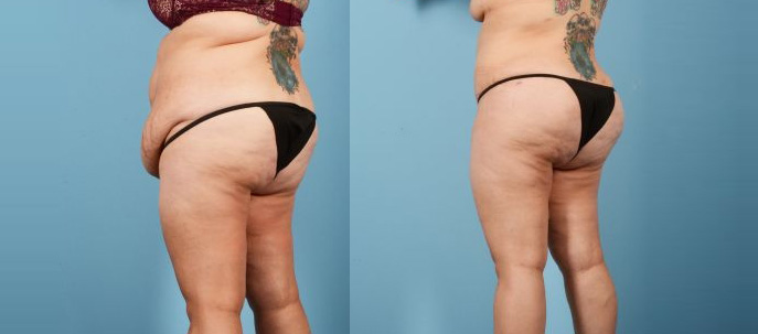 Liposuction Body - Before and After
