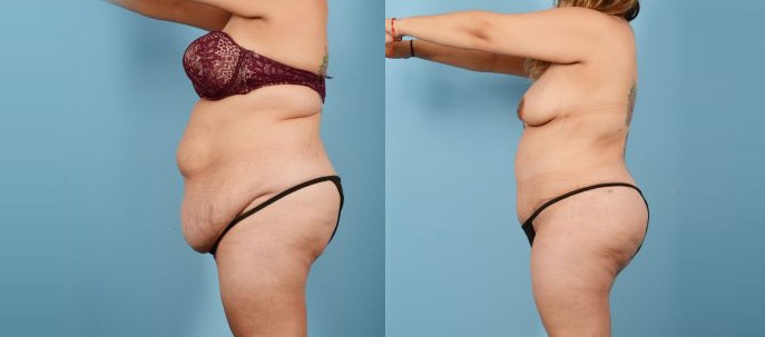 Liposuction Body - Before and After