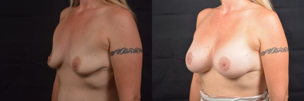 Breast augmentation before & after