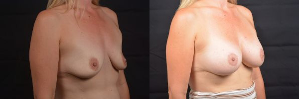 Breast augmentation before & after
