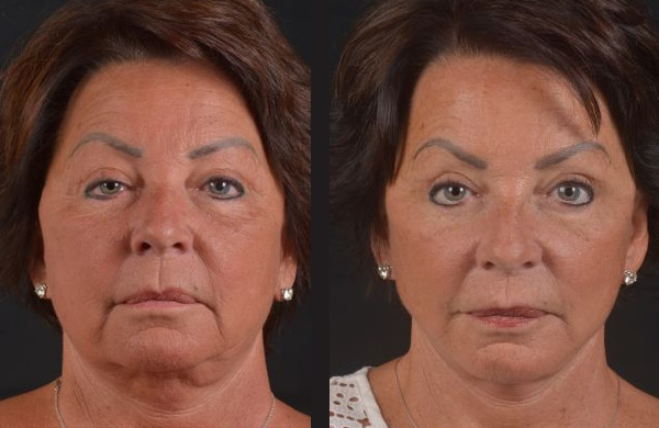 Facelift - Before and After