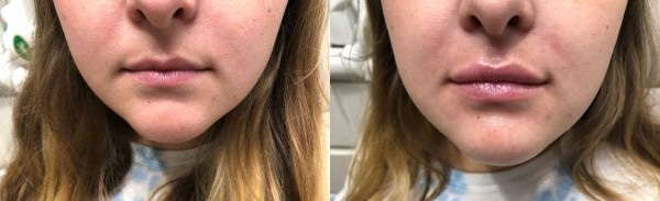 Juvederm - Before and After