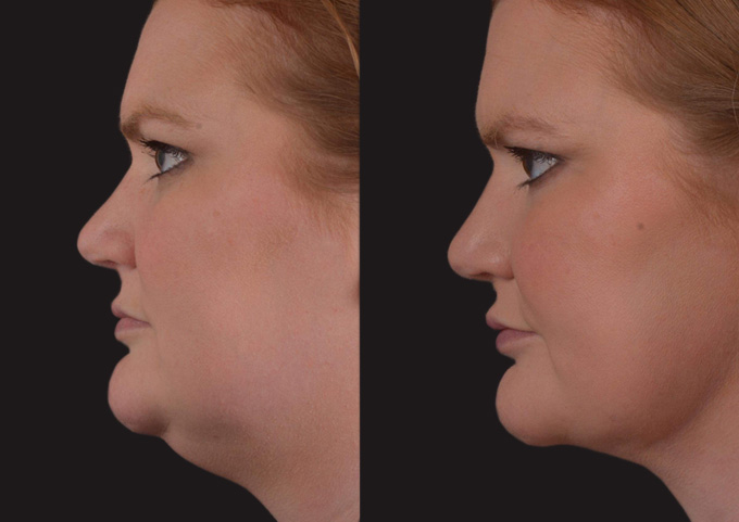 Neck Liposuction Before and After