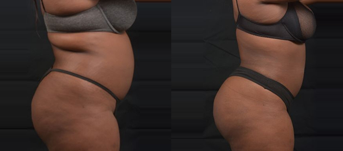 Butt Lift - Before and After