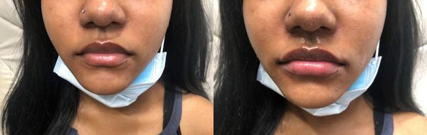 Restylane - Before and After