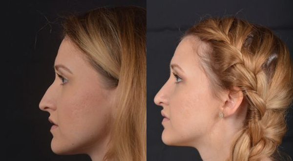 Rhinoplasty - Before and After