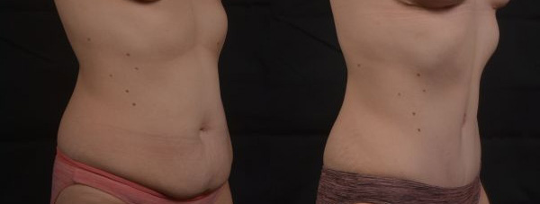 Tummy Tuck - Before and After
