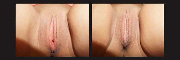 Fat Grafting to Labia - Before and After