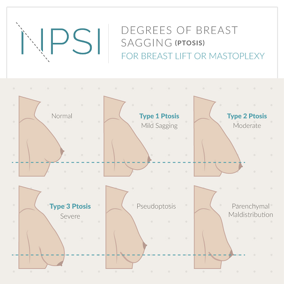 See the range of degrees of sagging that can be addressed with a breast lift at Nashville Plastic Surgery Institute.