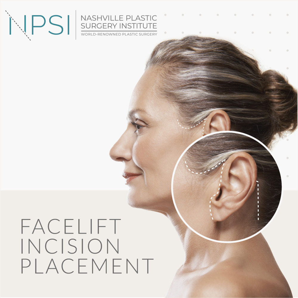 Nashville Plastic Surgery Institute uses minimal scar techniques to meet the needs of each Nashville facelift patient as an individual.