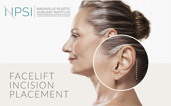 Nashville Plastic Surgery Institute uses minimal scar techniques to meet the needs of each Nashville facelift patient as an individual.