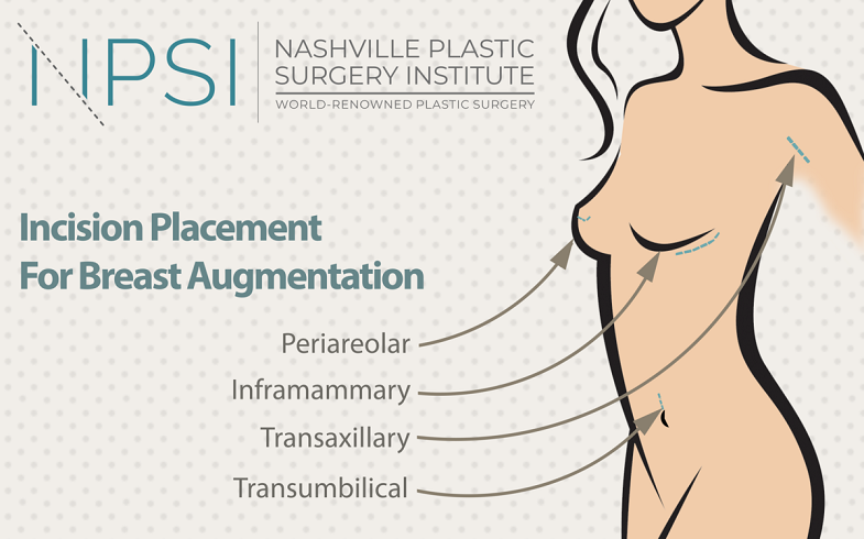 Breast augmentation at our Nashville, TN, practice can involve one of four incision locations: periareolar, transaxillary, transumbilical, or inframammary.