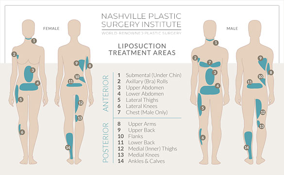 Nashville Plastic Surgery Institute offers posterior and anterior liposuction treatments in Nashville for both men and women who want a more toned body.