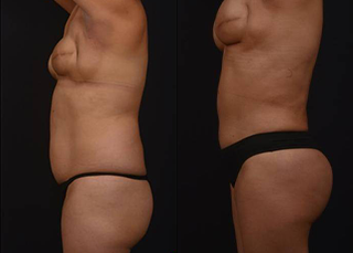 Liposuction 360 and Brazilian Butt Lift - Before and After