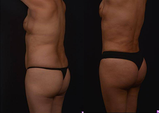Liposuction 360 and Brazilian Butt Lift - Before and After