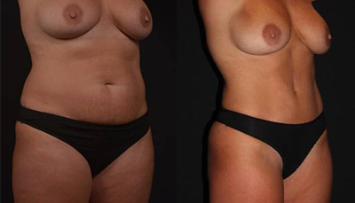 Tummy Tuck - Before and After