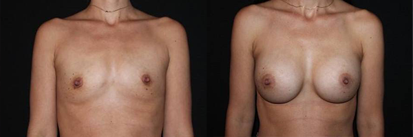 Breast Augmentation - Before and After
